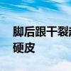 脚后跟干裂起硬皮怎么办 如何处理脚后跟起硬皮