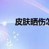 皮肤晒伤怎么办 皮肤晒伤后修复措施
