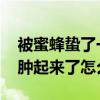 被蜜蜂蛰了一下该怎么处理 被蜜蜂蛰了一下肿起来了怎么办