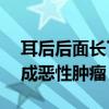 耳后后面长了这个鼓包, 可要当心了, 容易形成恶性肿瘤