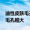 油性皮肤毛孔粗大怎么办 油性皮肤如何改善毛孔粗大