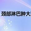 颈部淋巴肿大严重吗（颈部淋巴肿大的原因）