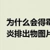 为什么会得霉菌性阴炎排出物图片（霉菌性阴炎排出物图片）