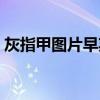 灰指甲图片早期怎么治疗方法（灰指甲图片）