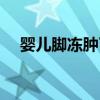 婴儿脚冻肿了怎么办（脚冻肿了怎么办）