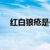 红白狼疮是什么病啊严重吗（红白狼疮）