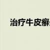 治疗牛皮癣最好医院（深圳牛皮癣医院）