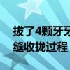 拔了4颗牙牙缝收拢过程视频（拔了4颗牙牙缝收拢过程）