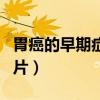 胃癌的早期症状图片大全（胃癌的早期症状图片）