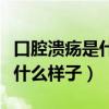 口腔溃疡是什么样子的怎么治疗（口腔溃疡是什么样子）