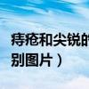 痔疮和尖锐的区别图片大全（痔疮和尖锐的区别图片）