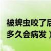 被蜱虫咬了后多久没事就没事了（被蜱虫咬了多久会病发）