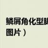 鳞屑角化型脚癣图片和症状（鳞屑角化型脚癣图片）