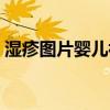 湿疹图片婴儿初期症状图片（湿疹图片婴儿）