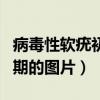 病毒性软疣初期的图片是什么（病毒性软疣初期的图片）
