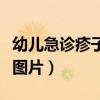 幼儿急诊疹子出在哪些部位（幼儿急诊的疹子图片）