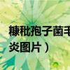 糠秕孢子菌毛囊炎图片大全（糠秕孢子菌毛囊炎图片）