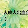人咬人出血会留疤吗（人咬人出血需要打针吗）