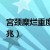 宫颈糜烂重度是癌症吗（宫颈糜烂重度癌变征兆）