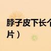 脖子皮下长个小硬包疼（脖子皮下长硬疙瘩图片）