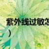 紫外线过敏怎么治能去根（紫外线过敏怎么办）