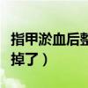 指甲淤血后整个指甲空了（指甲淤血后空了要掉了）
