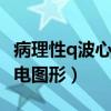 病理性q波心电图形与正常q波（病理性q波心电图形）
