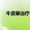 牛皮廨治疗什么特效药膏（牛皮廨治疗）