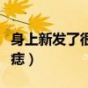身上新发了很多颗黑痣（身上新长了很多小黑痣）