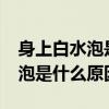 身上白水泡是什么原因引起的?（身上起白水泡是什么原因）