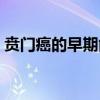 贲门癌的早期能治愈吗（贲门癌的早期症状）