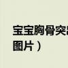 宝宝胸骨突出图片 一高一低（宝宝胸骨突出图片）